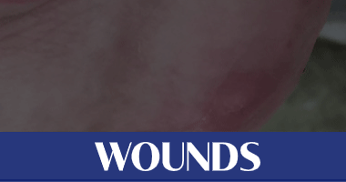 Using Augmented Reality to Improve Patient Outcomes With Negative Pressure Wound Therapy - Wound Care Weekly