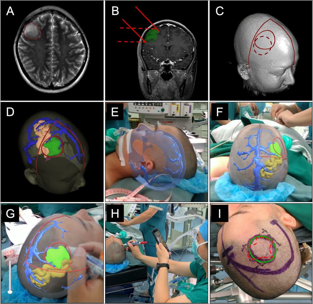 Real‐time augmented reality application in presurgical planning and lesion scalp localization by a smartphone - Neurosurgery Blog